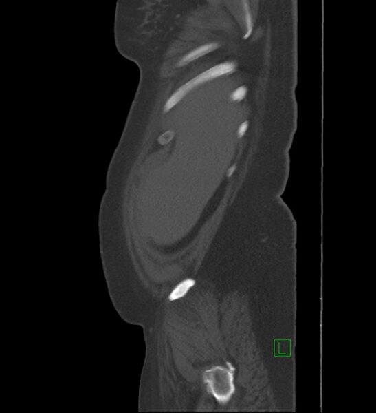File:Chromophobe renal cell carcinoma (Radiopaedia 84239-99519 Sagittal bone window 98).jpg