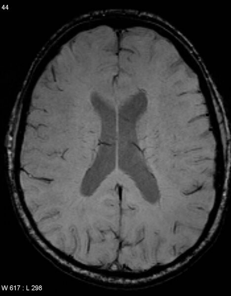 File:Chronic lymphocytic inflammation with pontine perivascular enhancement responsive to steroids (CLIPPERS) (Radiopaedia 37520-39374 Axial SWI 43).jpg
