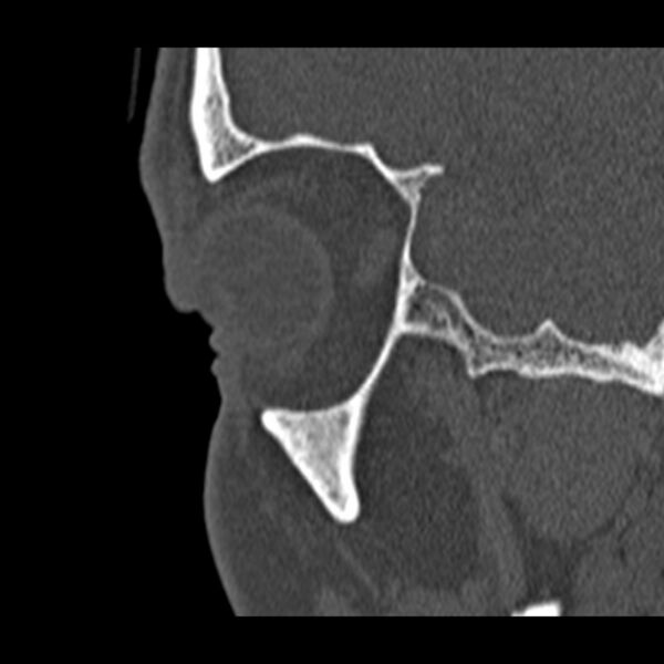 File:Chronic maxillary sinusitis (Radiopaedia 27879-28116 Sagittal bone window 2).jpg