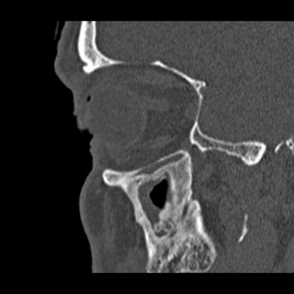 File:Chronic maxillary sinusitis (Radiopaedia 27879-28116 Sagittal bone window 46).jpg