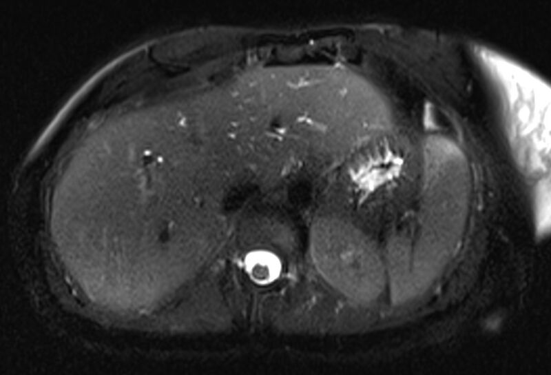 File:Chronic pancreatitis - pancreatic duct calculi (Radiopaedia 71818-82250 Axial T2 fat sat 15).jpg