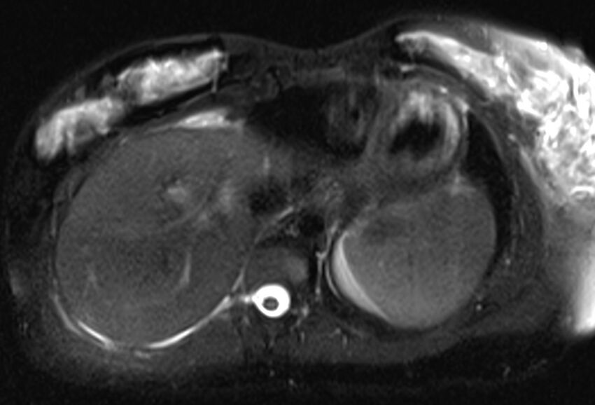 Chronic pancreatitis - pancreatic duct calculi (Radiopaedia 71818-82250 Axial T2 fat sat 7).jpg