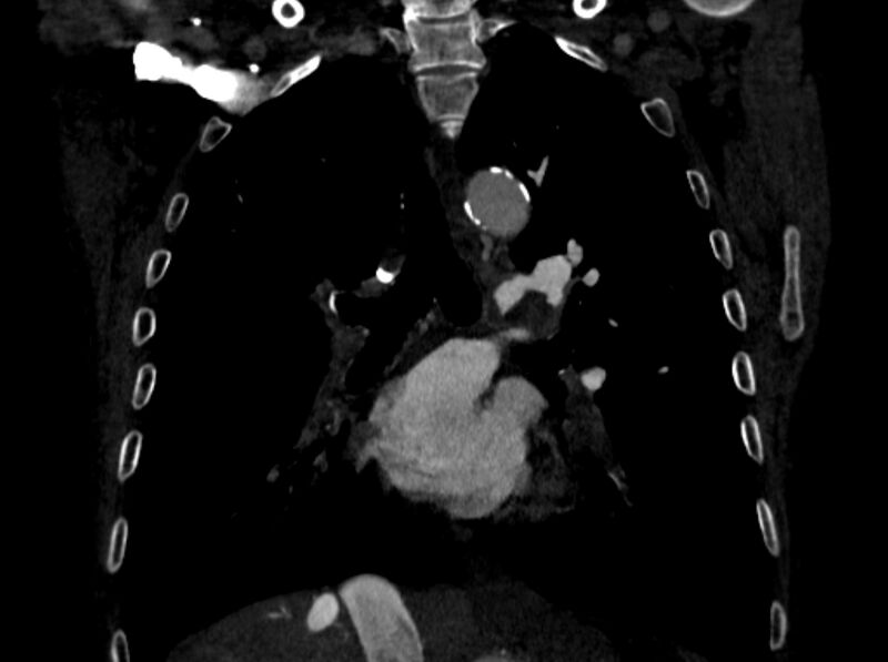 File:Chronic pulmonary embolism (Radiopaedia 91241-108843 A 60).jpg