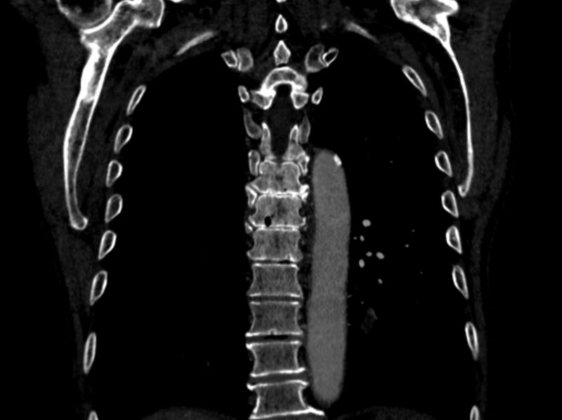 File:Chronic pulmonary embolism (Radiopaedia 91241-108843 A 86).jpg