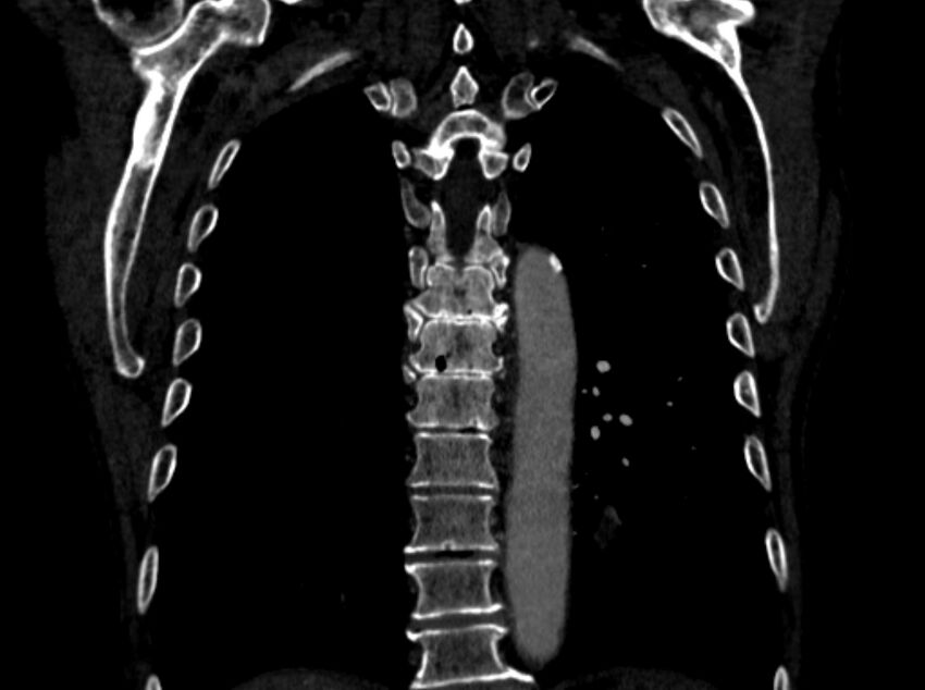 Chronic pulmonary embolism (Radiopaedia 91241-108843 A 86).jpg