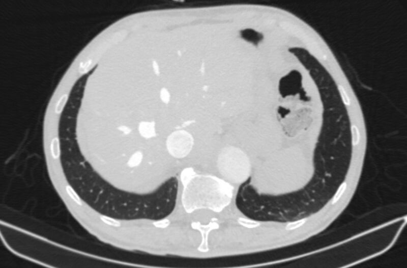 File:Chronic pulmonary embolism (Radiopaedia 91241-108843 Axial lung window 84).jpg