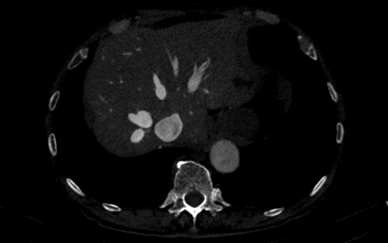 File:Chronic pulmonary embolism (Radiopaedia 91241-108843 B 168).jpg