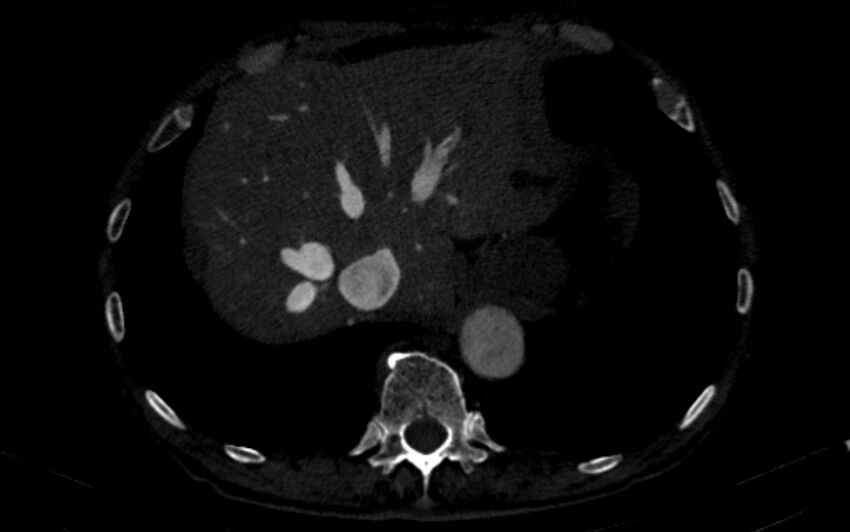 Chronic pulmonary embolism (Radiopaedia 91241-108843 B 168).jpg