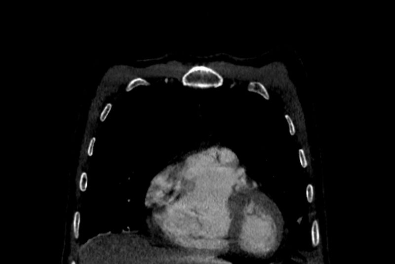 File:Chronic pulmonary embolism with bubbly consolidation (Radiopaedia 91248-108850 B 24).jpg