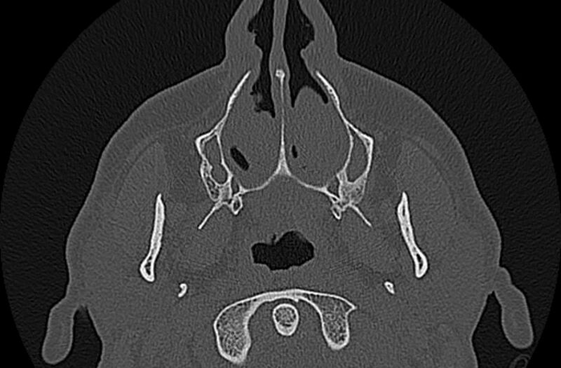 File:Chronic rhinosinusitis (Radiopaedia 65079-74075 Axial bone window 11).jpg