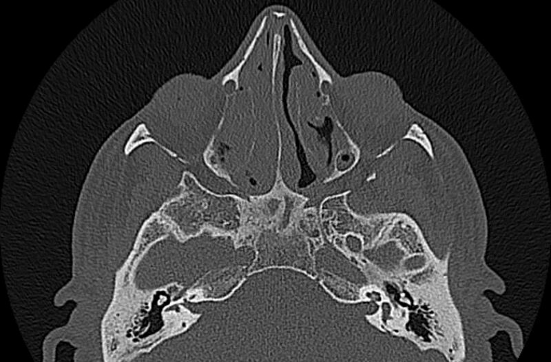 File:Chronic rhinosinusitis (Radiopaedia 65079-74075 Axial bone window 41).jpg