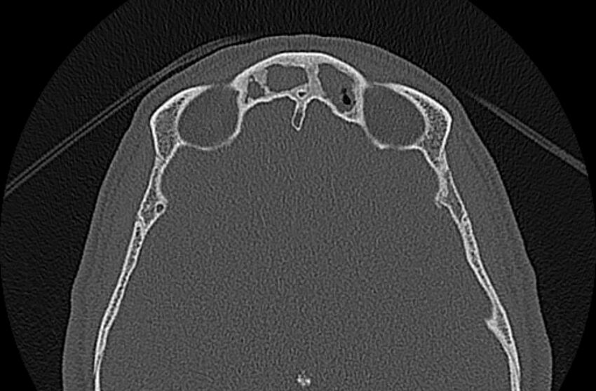 Chronic rhinosinusitis (Radiopaedia 65079-74075 Axial bone window 72).jpg