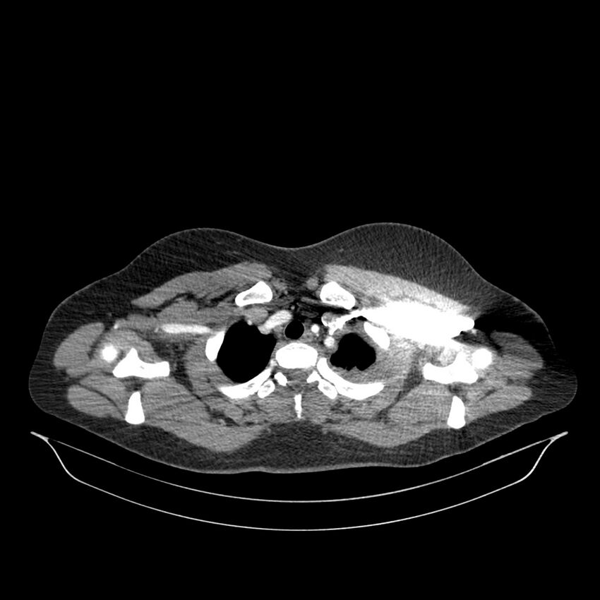 Chronic thromboembolic pulmonary hypertension (CTEPH) (Radiopaedia 74597-85532 Axial C+ CTPA 142).jpg