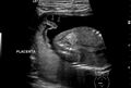 Circumvallate placenta (Radiopaedia 53147).jpg