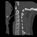 Clay-shoveler fracture (Radiopaedia 22568-22590 Sagittal bone window 26).jpg