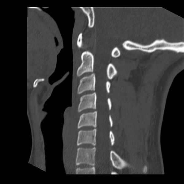 File:Clay-shoveler fracture (Radiopaedia 22568-22590 Sagittal bone window 26).jpg