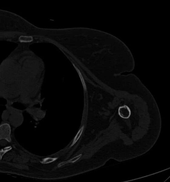 File:Clear cell chondrosarcoma - humerus (Radiopaedia 63104-71612 Axial bone window 76).jpg