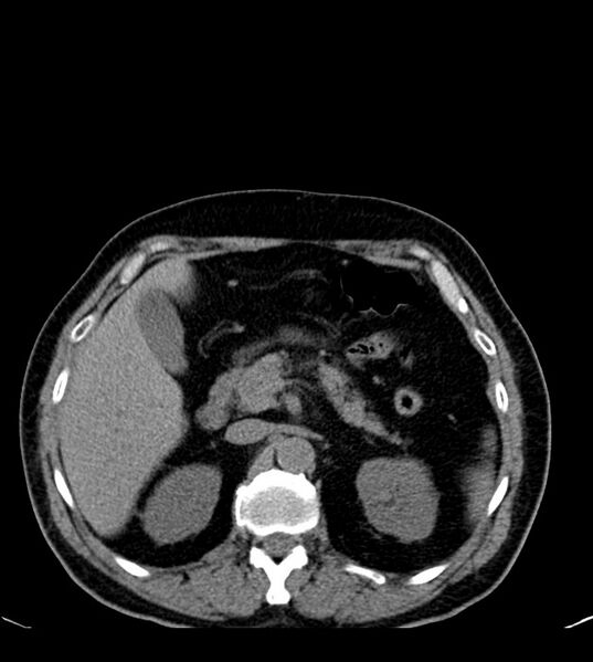 File:Clear cell renal cell carcinoma (Radiopaedia 85006-100539 Axial non-contrast 30).jpg
