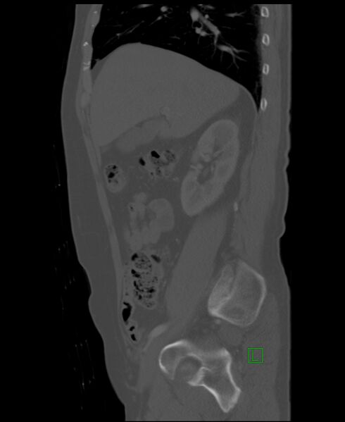 File:Clear cell renal cell carcinoma (Radiopaedia 85006-100539 Sagittal bone window 42).jpg