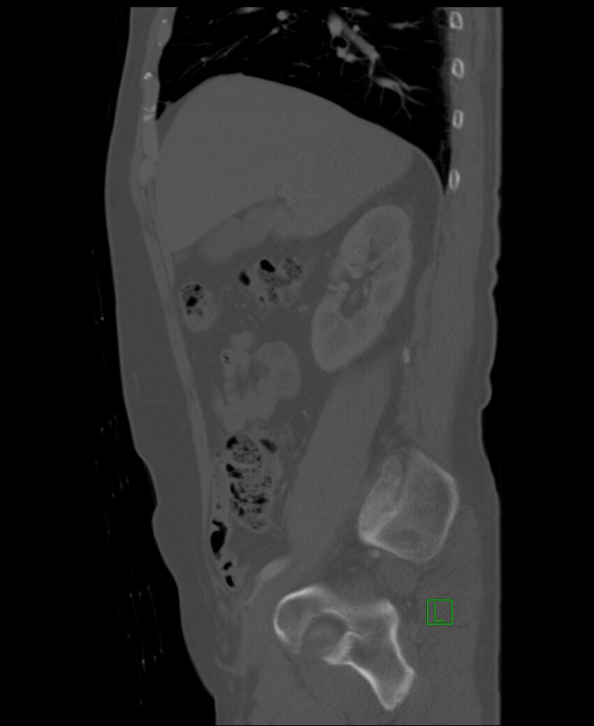 Clear cell renal cell carcinoma (Radiopaedia 85006-100539 Sagittal bone window 42).jpg