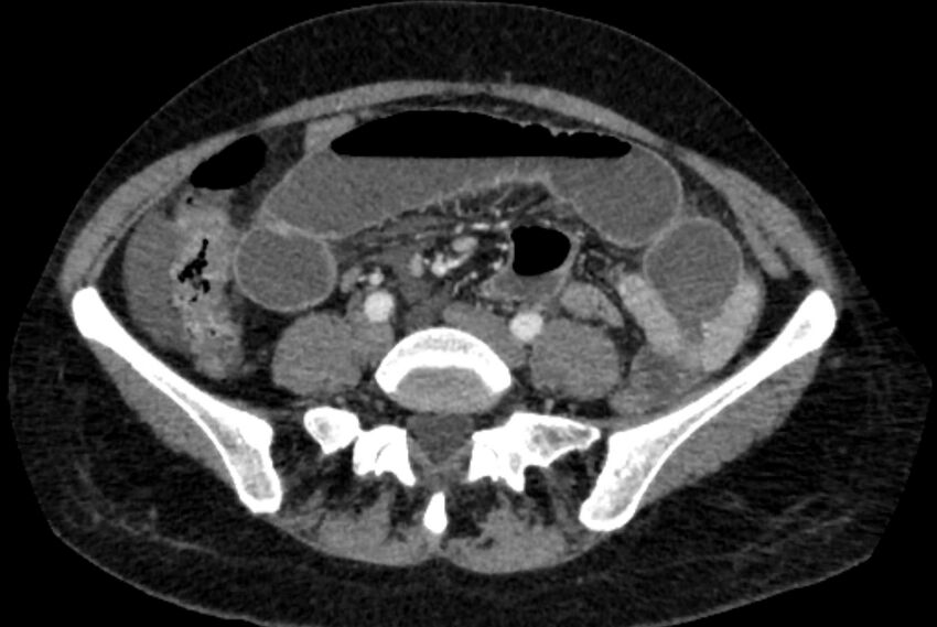 Closed loop small bowel obstruction (Radiopaedia 71211-81508 A 90).jpg