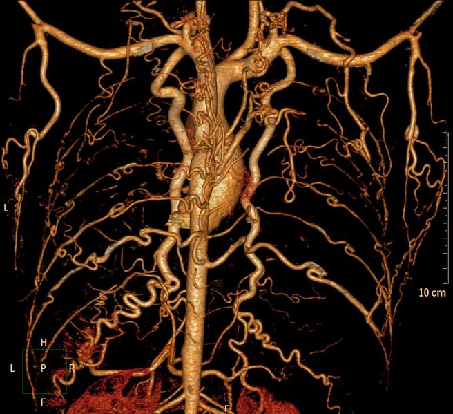 File:Coarctation of the aorta (Radiopaedia 27458-27657 3D 8).jpg