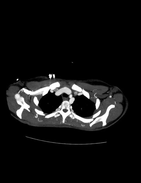 File:Coarctation of the aorta (Radiopaedia 27458-27657 D 5).jpg