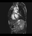 Coarctation of the aorta (Radiopaedia 43373-46729 C 12).jpg