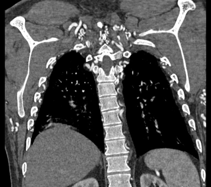 File:Coarctation of the aorta (Radiopaedia 53752-59822 B 62).jpg