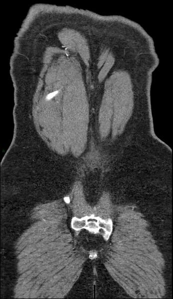 File:Coarctation of the aorta (Radiopaedia 74632-88521 B 245).jpg