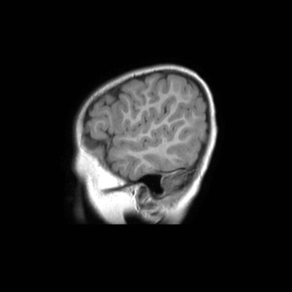 File:Cochlear nerve aplasia - unilateral (Radiopaedia 87910-104413 Sagittal T1 41).jpg