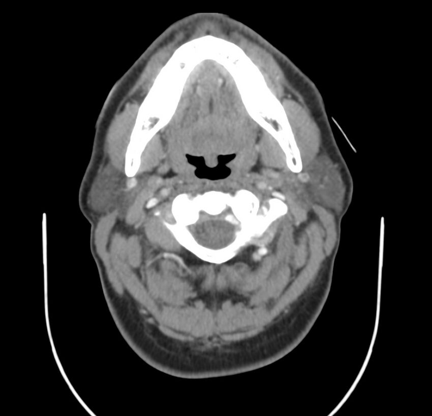 Colloid cyst of thyroid (Radiopaedia 22897-22923 Axial C+ delayed 25).jpg