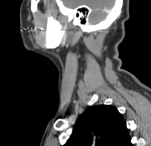 File:Colloid cyst of thyroid (Radiopaedia 22897-22923 Sagittal C+ delayed 15).jpg