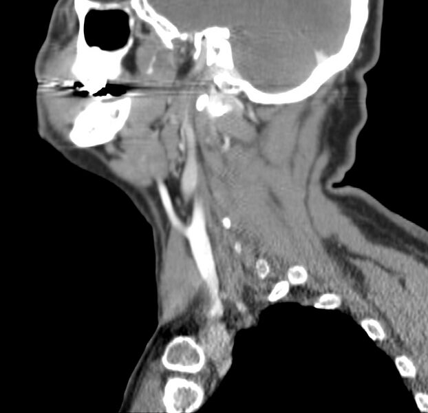 File:Colloid cyst of thyroid (Radiopaedia 22897-22923 Sagittal C+ delayed 41).jpg