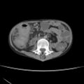 Colocolic fistula - Crohn disease (Radiopaedia 57063-63955 A 39).jpg