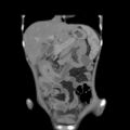 Colocolic fistula - Crohn disease (Radiopaedia 57063-63955 B 13).jpg
