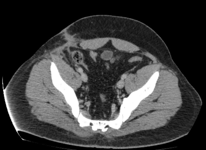 Colocutaneous fistula (Radiopaedia 56401-63062 A 79).jpg