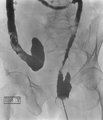 Colonic J-pouch (Radiopaedia 29919).png