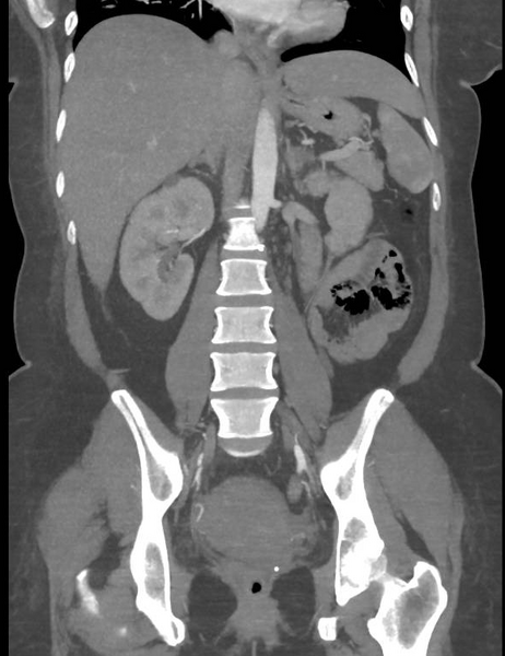 File:Colonic pseudo-obstruction (Radiopaedia 79752-92980 B 39).png