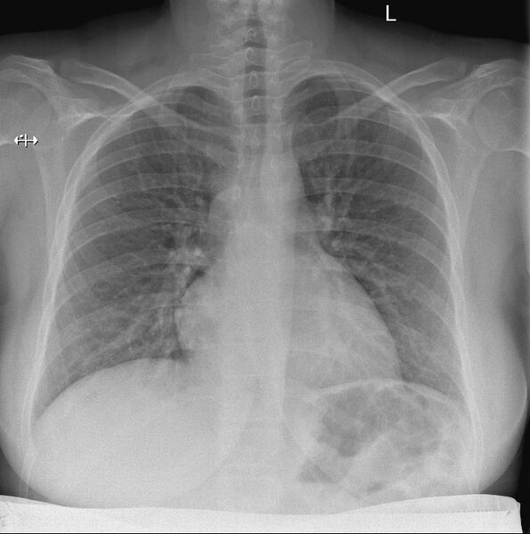 File:Lead gown on chest radiograph (Radiopaedia 73067).jpg