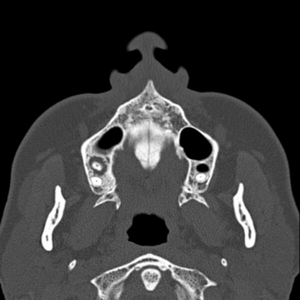 File:Nasal septal perforation (Radiopaedia 25030-25289 Axial bone window 1).jpg