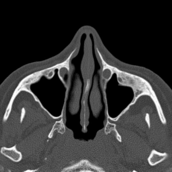 File:Nasolabial cyst (Radiopaedia 33987-35205 Axial bone window 18).jpg