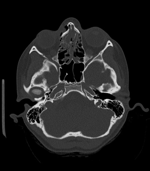 File:Nasoorbitoethmoid fracture (Radiopaedia 90044-107205 Axial bone window 76).jpg
