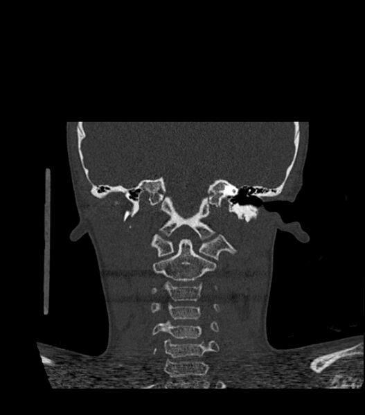 File:Nasoorbitoethmoid fracture (Radiopaedia 90044-107205 Coronal bone window 99).jpg