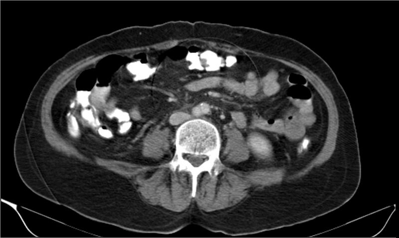 File:Necrotizing pancreatitis (Radiopaedia 20595-20495 A 26).jpg
