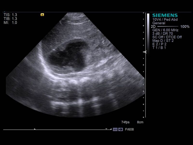 File:Neonatal adrenal hemorrhage (Radiopaedia 40215-42740 Longitudinal 1).JPG