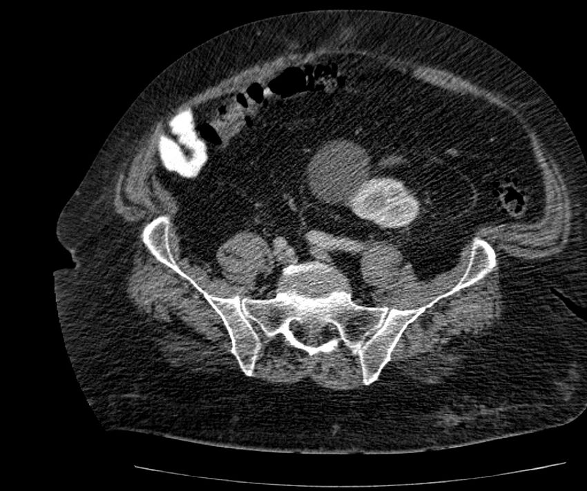 Nephroptosis with inguinal hernia containing perirenal fat (Radiopaedia 56632-63391 C 250).jpg