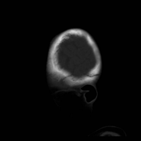 File:Neuroblastoma with skull metastases (Radiopaedia 30326-30958 Sagittal bone window 3).jpg