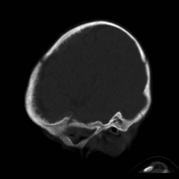 File:Neuroblastoma with skull metastases (Radiopaedia 30326-30958 Sagittal bone window 34).jpg