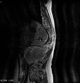 Neurofibromatosis type 2 - cranial and spinal involvement (Radiopaedia 5351-7112 B 1).jpg